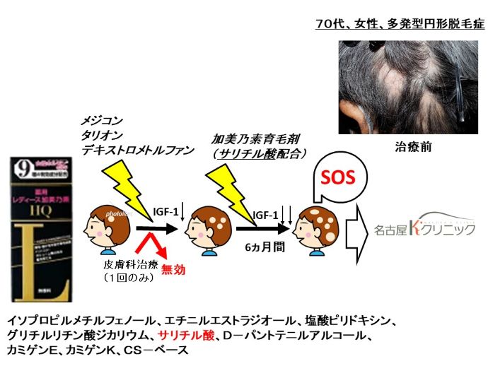 円形脱毛症　病院